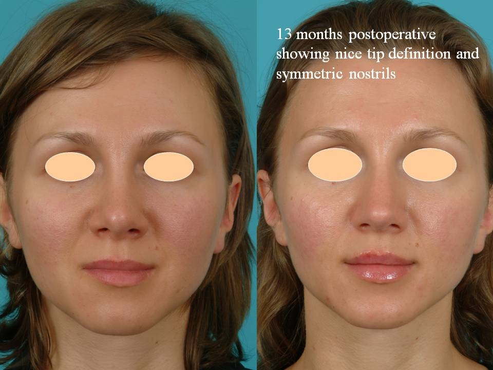 endonasal rhinoplasty