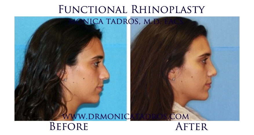 endonasal rhinoplasty