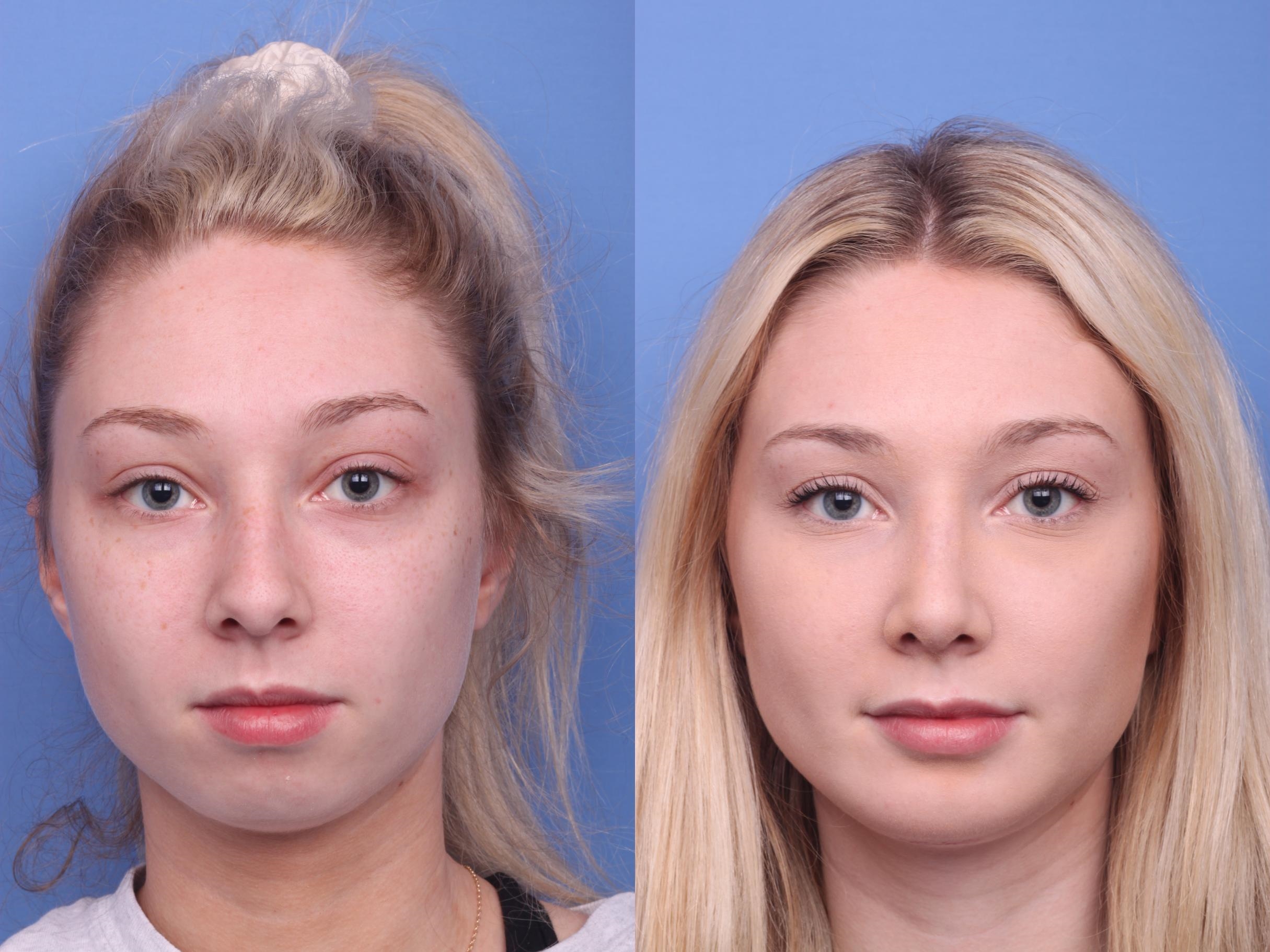 endonasal rhinoplasty